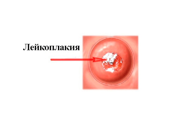 Лейкоплакия шейки матки